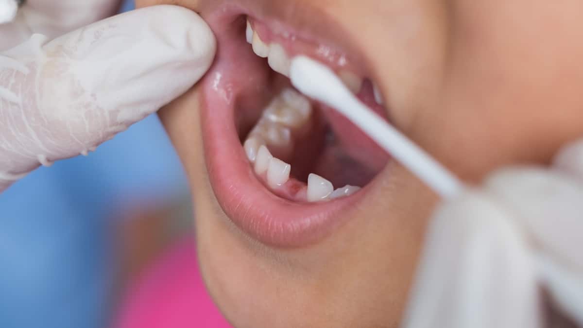Dental Fluoride in Orlando, Florida