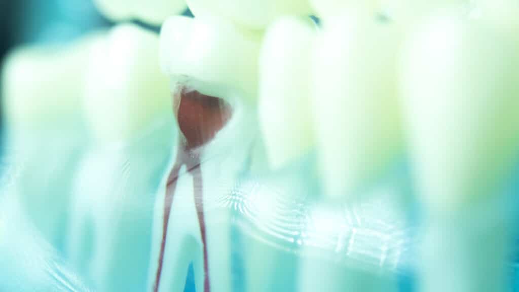 Dental Root Canals in Orlando, Florida